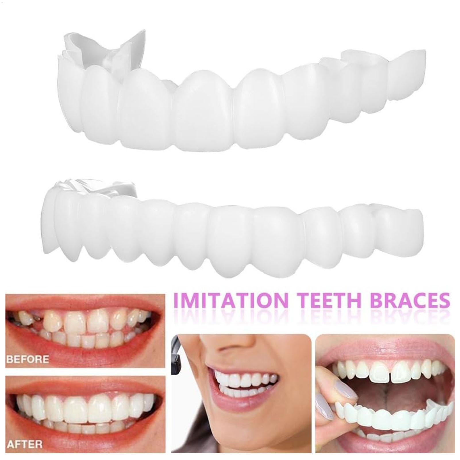 Teeth Whitening For Braces - Copertura Dentale Superiore e Inferiore per