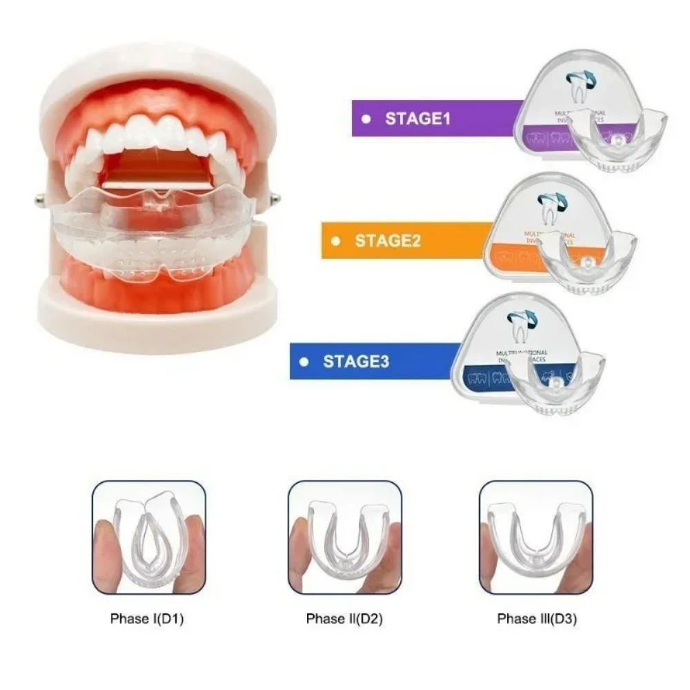 Teeth Whitening For Braces - Apparecchio Ortodontico per Raddrizzare i Denti,