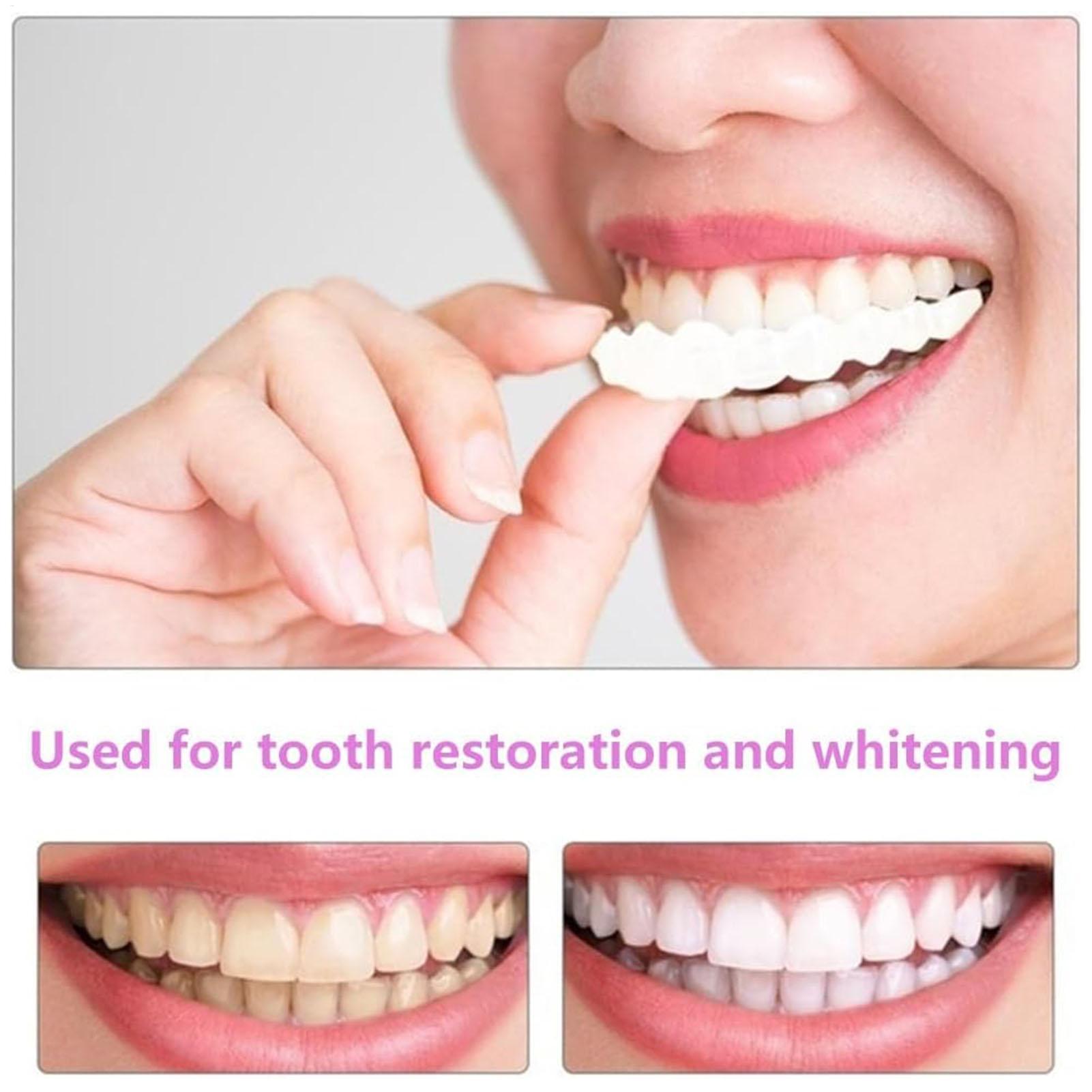 Copertura Dentale Superiore e  - Teeth Whitening For Braces recensione e prezzo