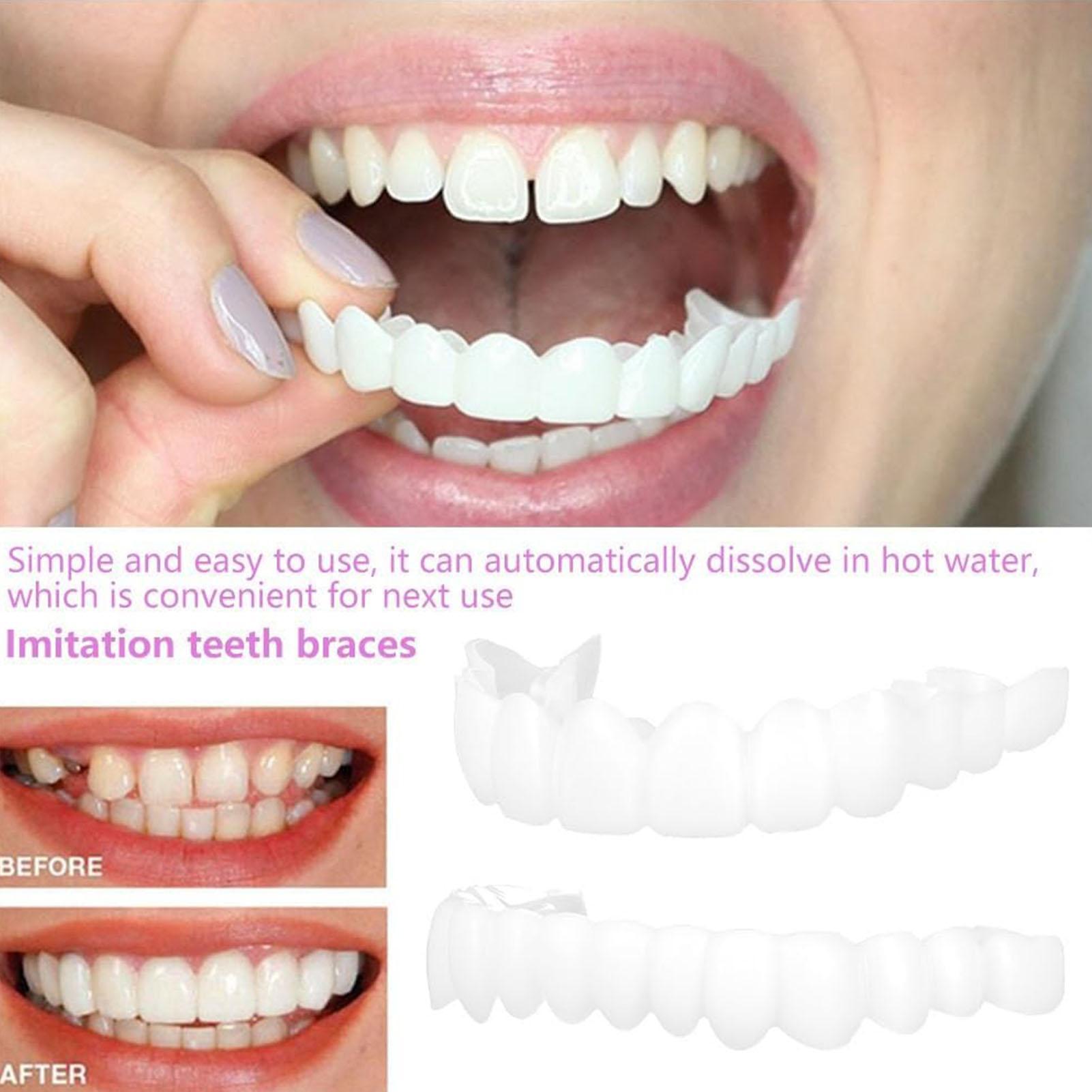 Copertura Dentale Superiore e  - Teeth Whitening For Braces recensione e prezzo