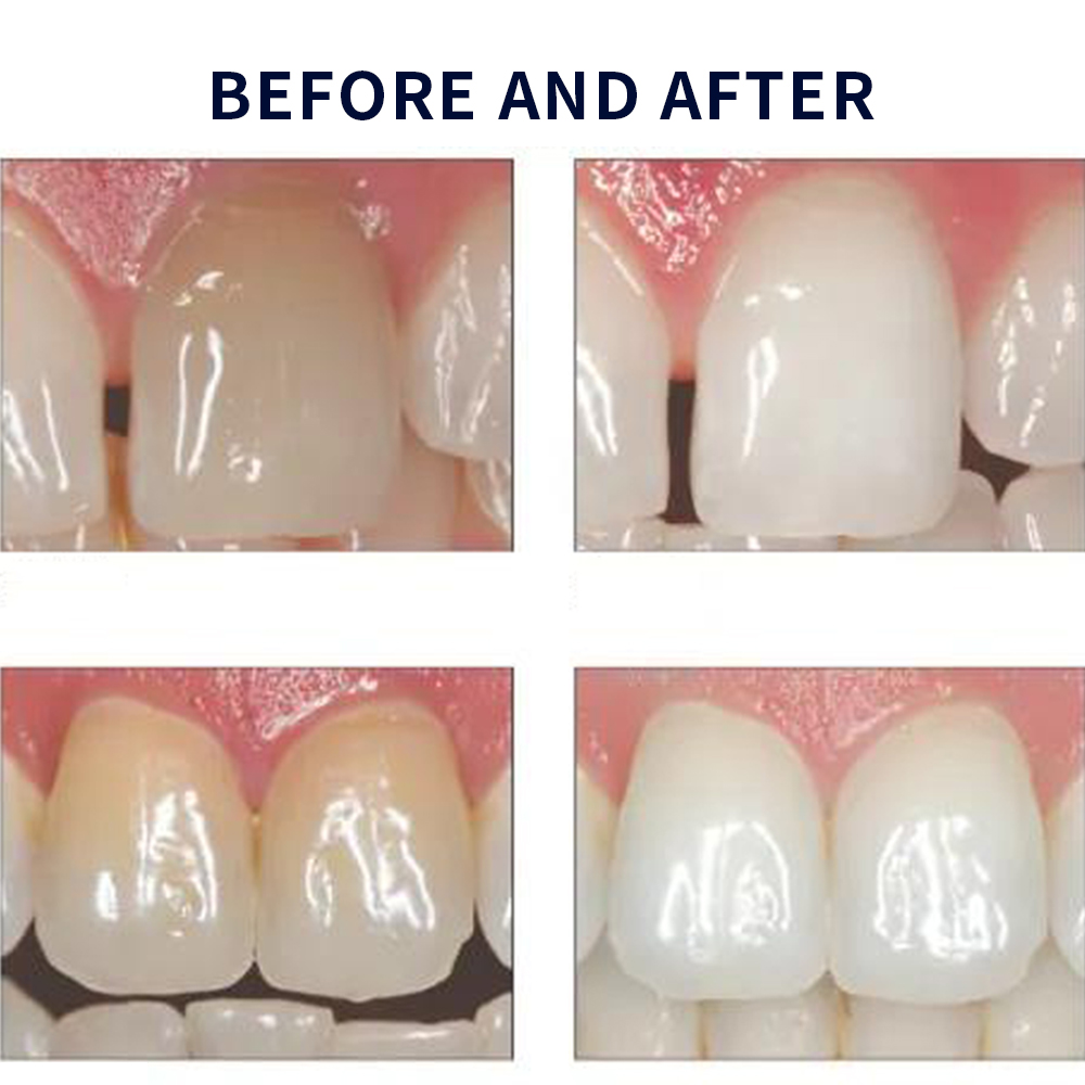 Opalescence Whitening 20% PF 2 - Teeth Whitening Kit At Home recensione e prezzo
