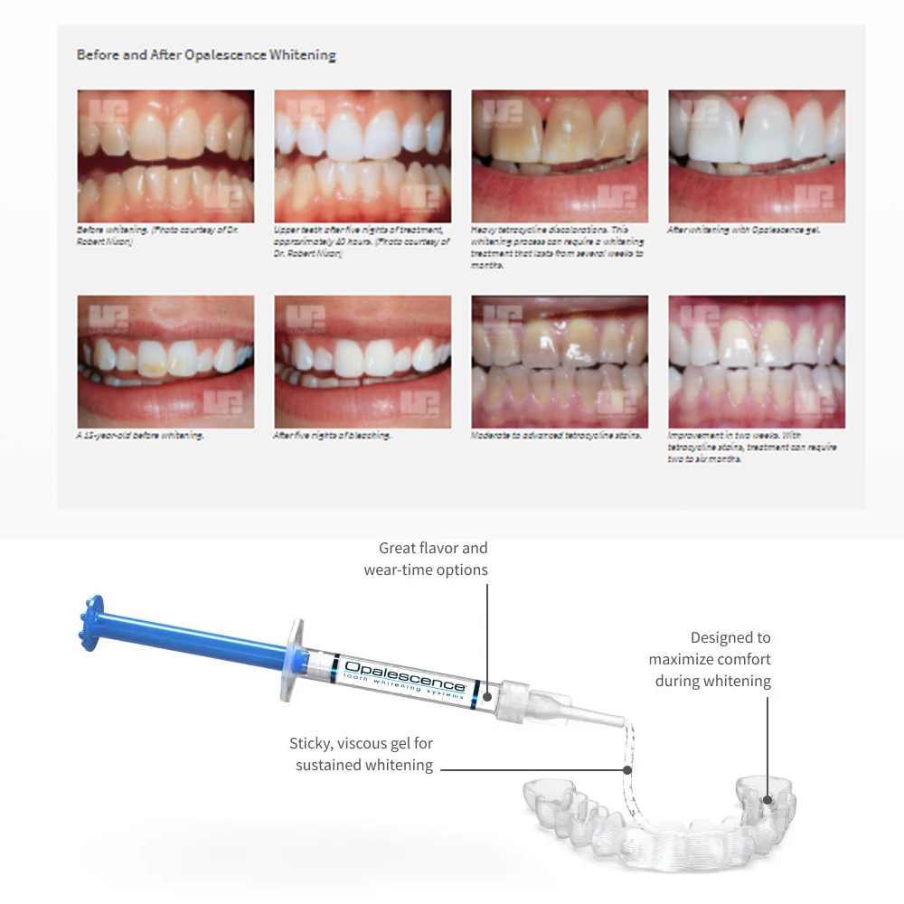 Opalescence Whitening 20% PF 2 - Teeth Whitening Kit At Home recensione e prezzo