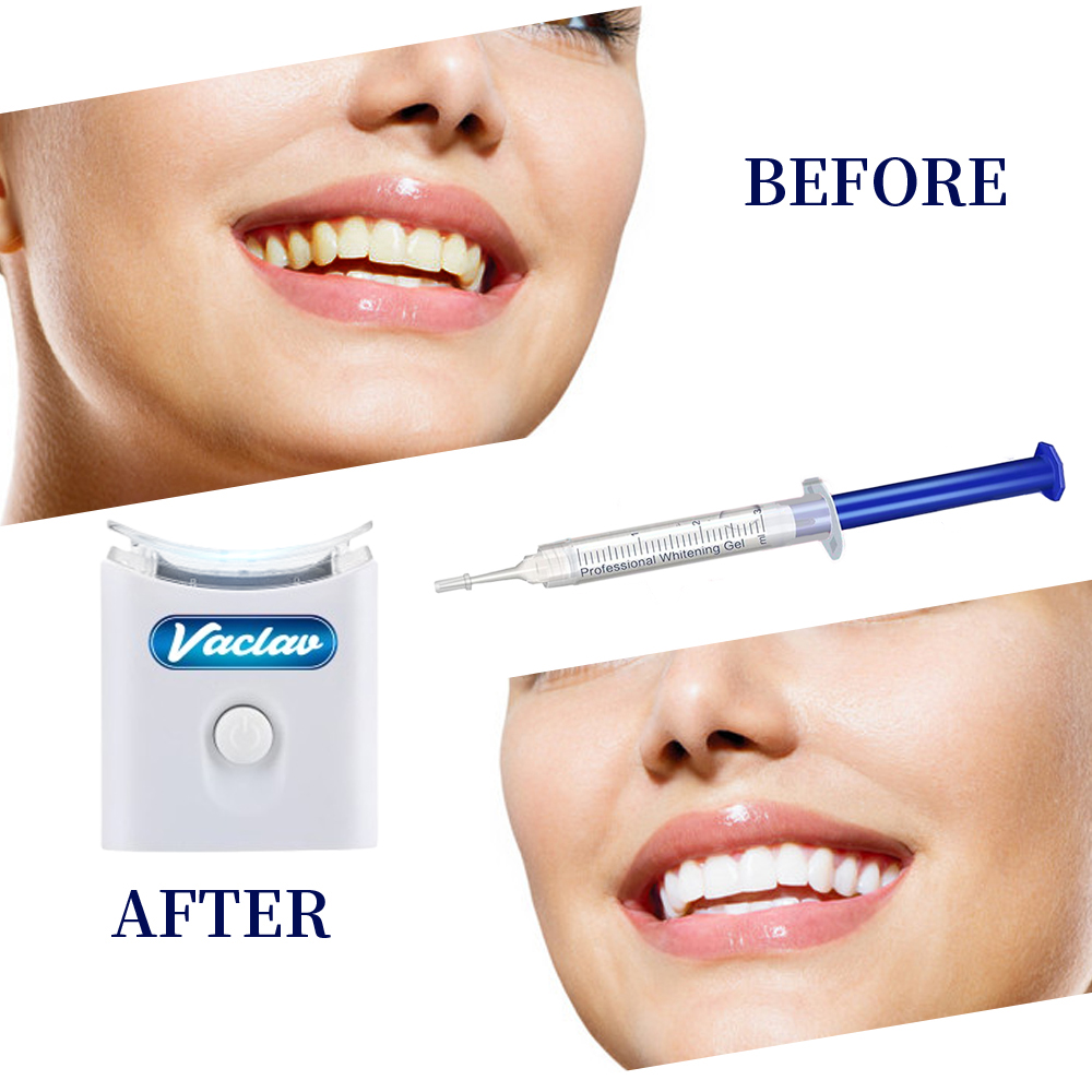 Menta Sbiancamento Dei Denti G - Teeth Whitening Kit At Home recensione e prezzo