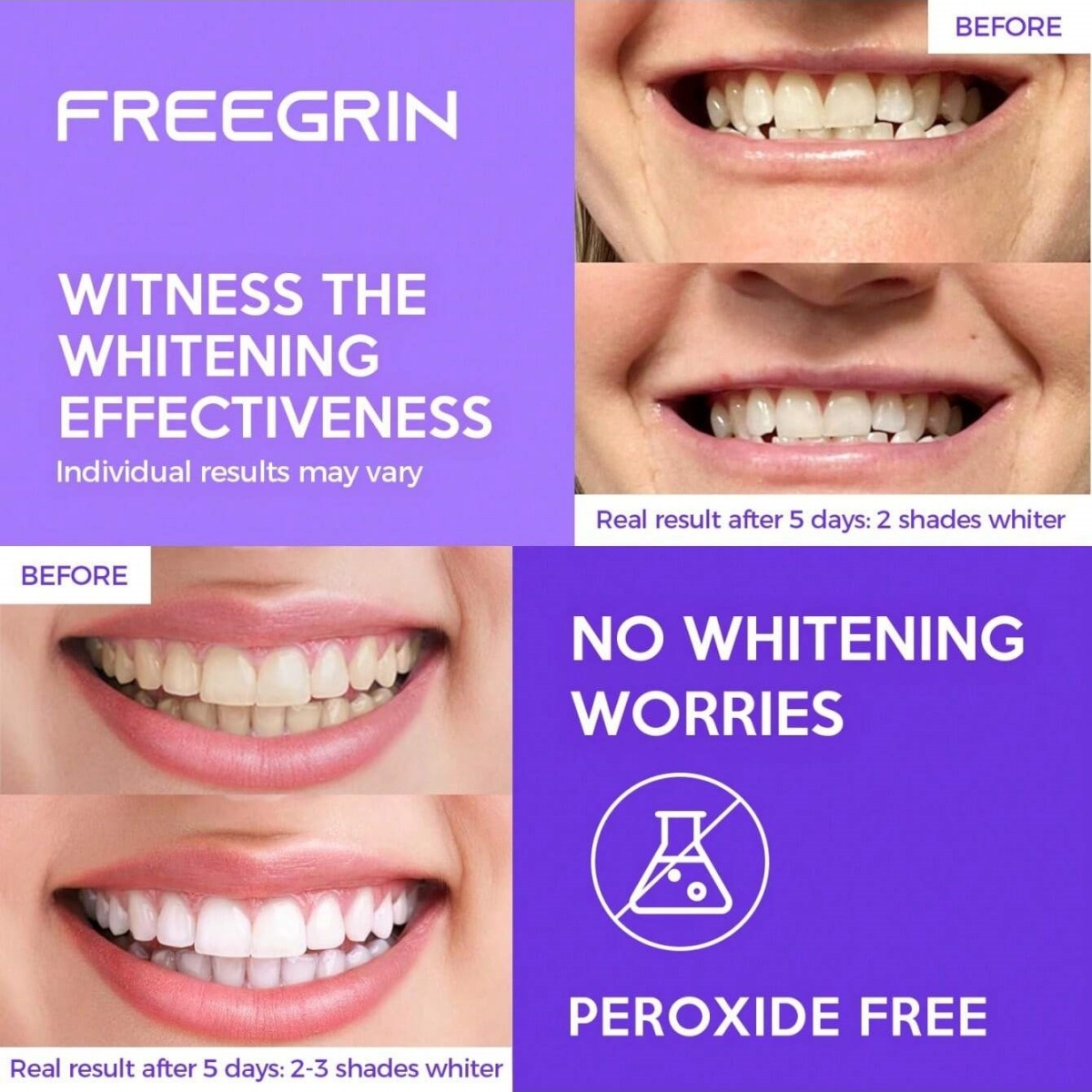Adesivi sbiancanti per denti d - Teeth Whitening Before And After recensione e prezzo