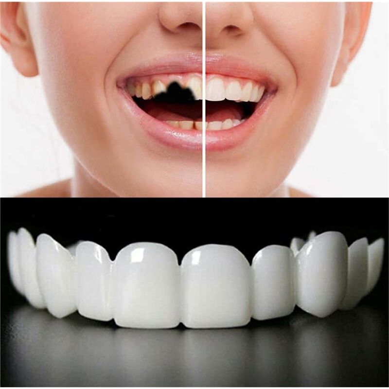 [NUOVO! ABMK] 2 Paia, Ripristi - Teeth Whitening For Braces recensione e prezzo
