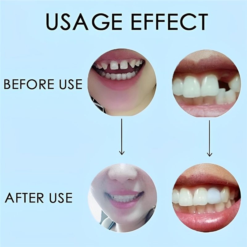 [NUOVO! ABMK] 2 Paia, Ripristi - Teeth Whitening For Braces recensione e prezzo